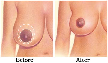 breast_reduction_surgery_1