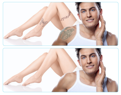 tattoo-removal-laser